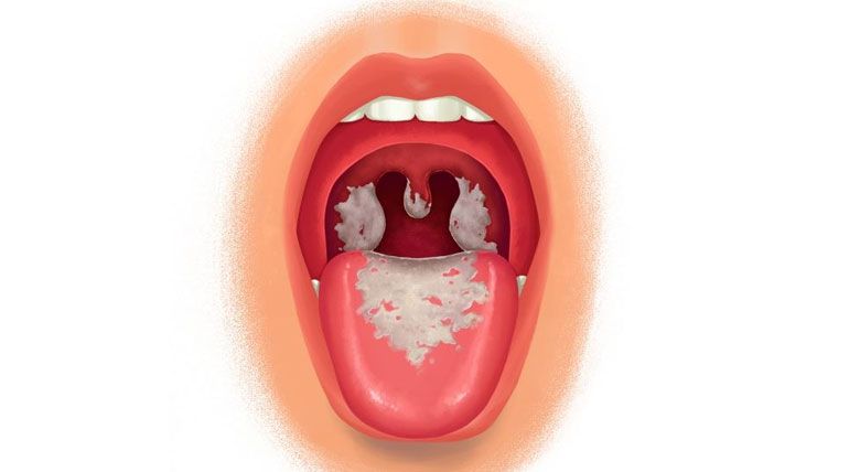 Bệnh bạch hầu là bệnh nhiễm khuẩn cấp tính có giả mạc ở tuyến hạnh nhân, hầu họng, thanh quản, mũi.