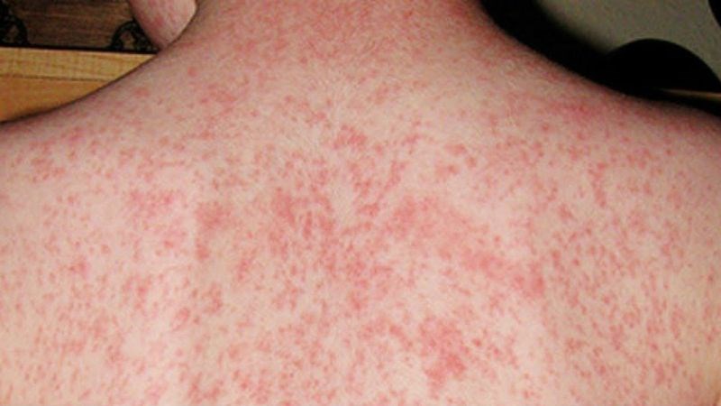 Những điều cần biết về BỆNH SỞI- Ảnh 5.