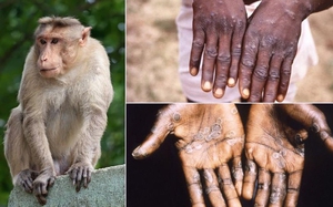 Bộ Y tế xếp đậu mùa khỉ vào bệnh truyền nhiễm nhóm B