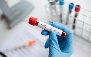 Điều kiện xác định người bị phơi nhiễm với HIV, bị nhiễm HIV do tai nạn rủi ro nghề nghiệp