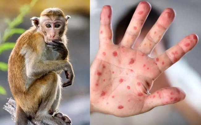 bệnh đậu mùa khỉ: Xem hình ảnh đậu mùa khỉ để hiểu thêm về bệnh tật mà chúng ta cần cảnh giác. Đồng thời, hình ảnh động vật này cũng sẽ giúp chúng ta thấy rõ ràng hơn vẻ đáng yêu của những con khỉ này.