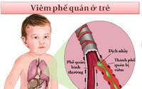 Cách chăm sóc trẻ bị viêm phế quản khi thời tiết chuyển mùa