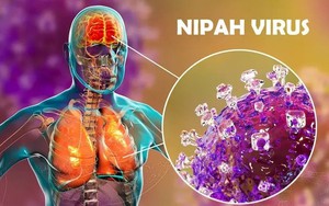 Virus Nipah là tác nhân truyền nhiễm nguy hiểm, tỉ lệ tử vong cao, chuyên gia khuyến cáo các biện pháp ứng phó