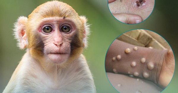 Các biện pháp phòng ngừa bệnh đậu mùa khỉ là gì?
